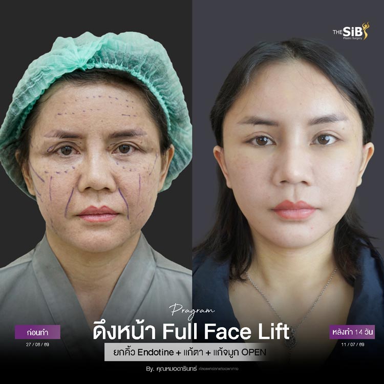 ปรึกษาประเมินใบหน้าอย่างละเอียดกับแพทย์เฉพาะทาง The SiB