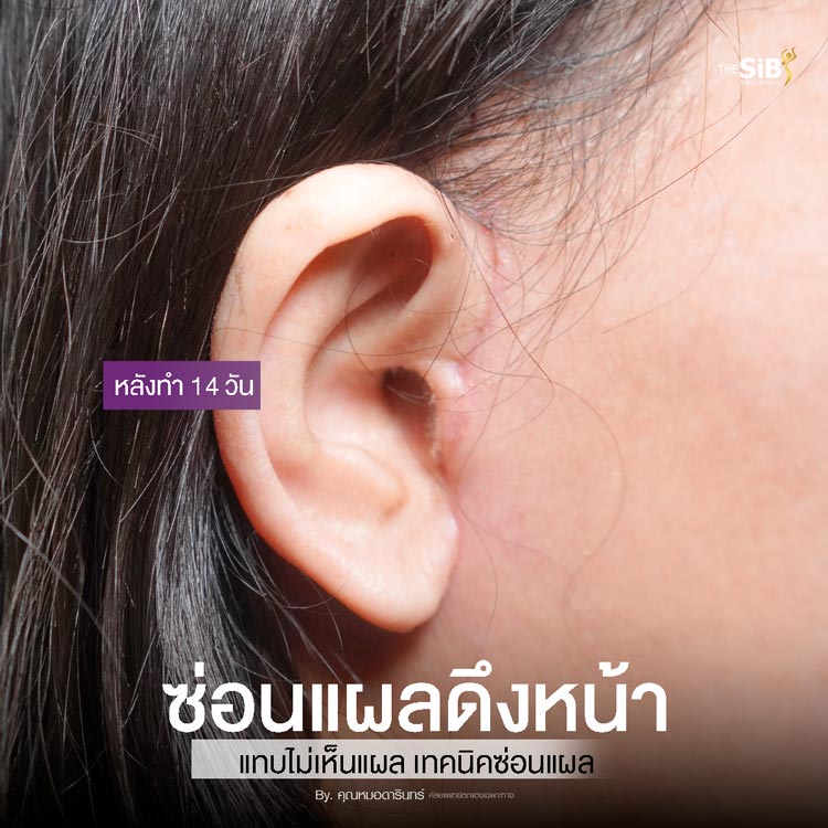 ภาพแผลดึงหน้าที่ The SiB Clinic