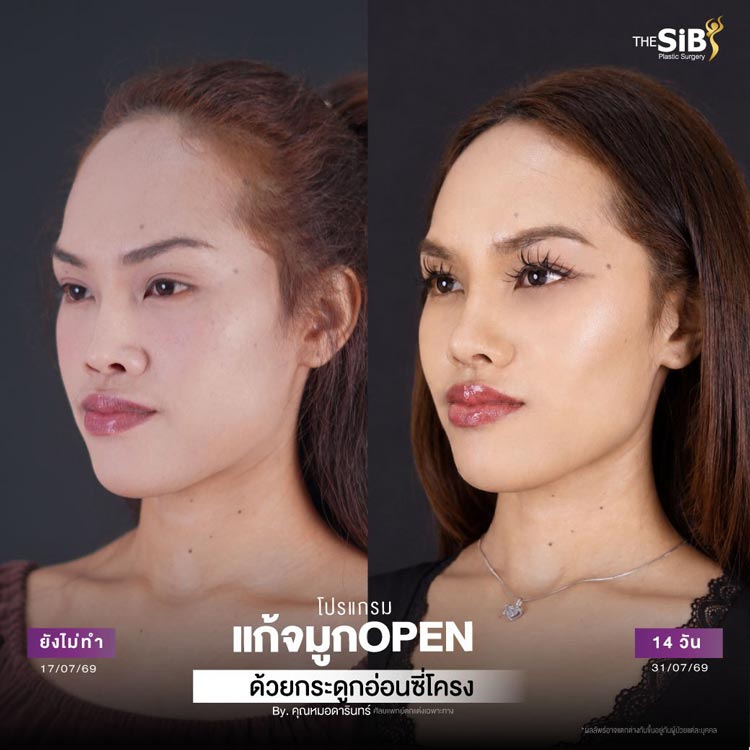 แก้จมูกเทคนิค Open ใช้กระดูกอ่อนซี่โครงตัวเอง