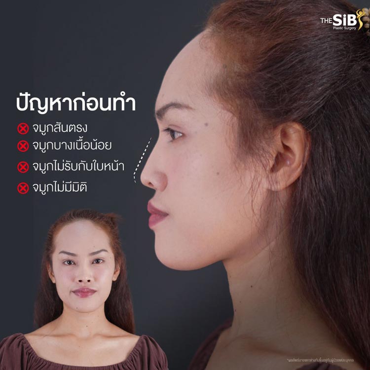 ปัญหาก่อนแก้จมูก ปลายจมูกใส เนื้อจมูกน้อย เสี่ยงทะลุ