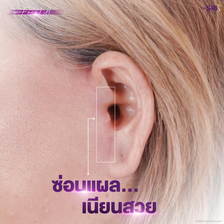 แผลดึงหน้า