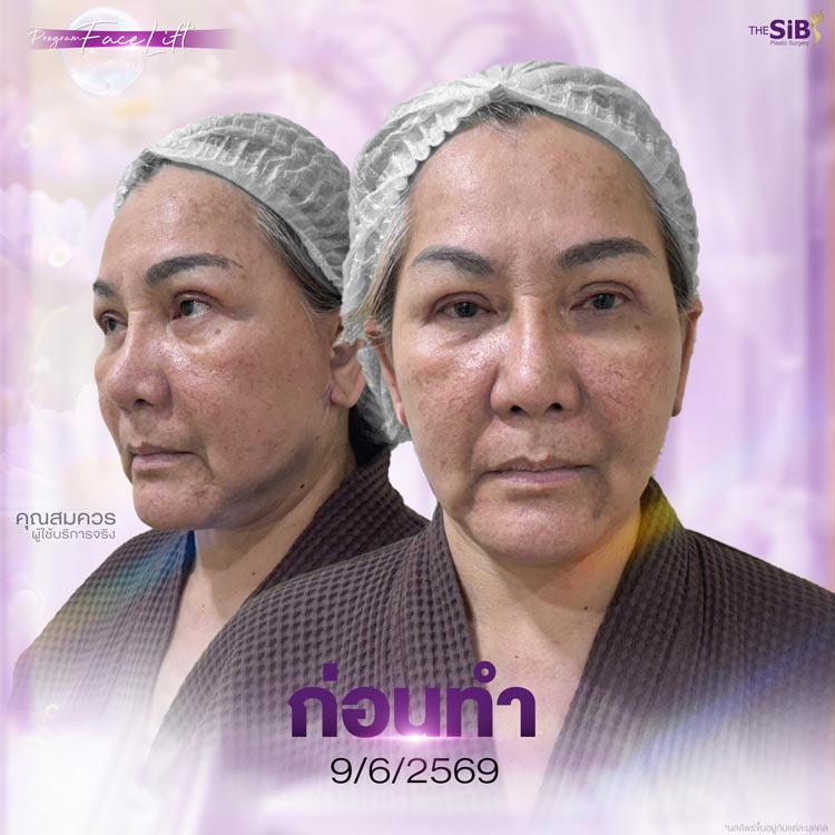 ปัญหาก่อนดึงหน้า ใบหน้าหย่อนคล้อย ผิวและรูปหน้าเปลี่ยนไปตามวัย