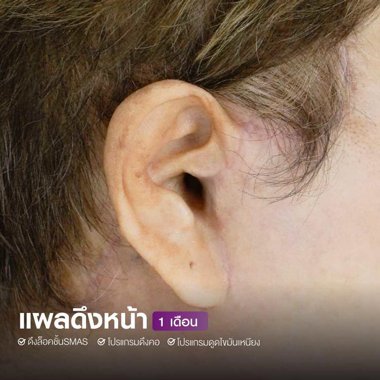 Planning a facelift revision for a Bell's Palsy case by a specialized doctor at The SiB