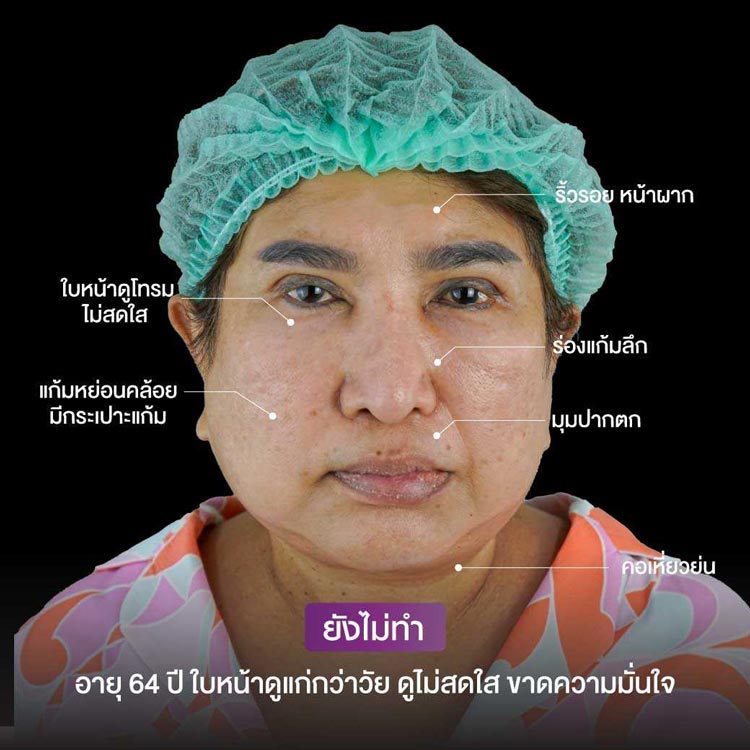 Pre-facelift revision issues: sagging and facial asymmetry