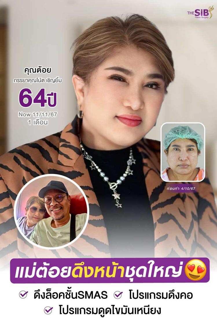 2-year facelift revision update: firm, youthful-looking face