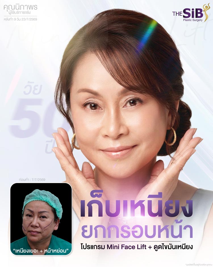 อัปเดตหลังทำดึงหน้า 16 วัน บวมช้ำน้อย ฟื้นตัวไว