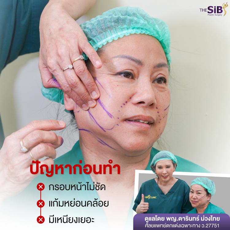 ปัญหาก่อนดึงหน้า แก้มหย่อนคล้อย กรอบหน้าไม่ชัด มีไขมันเหนียง