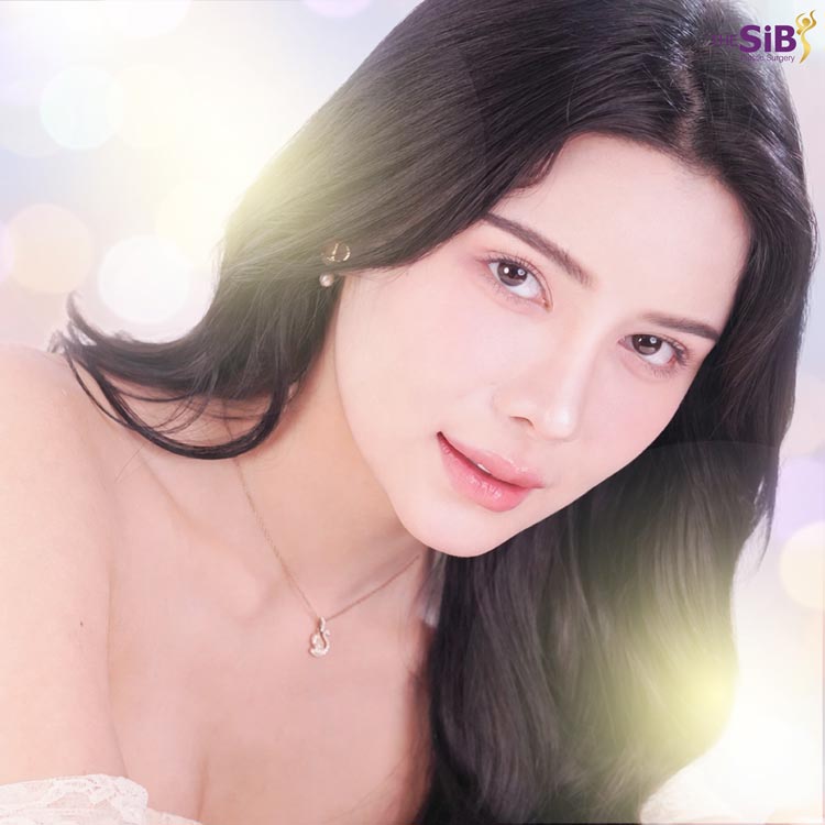 ผลลัพธ์แก้จมูก Open จมูกดูเล็กลงแต่ปลายพุ่ง สไตล์นางงาม