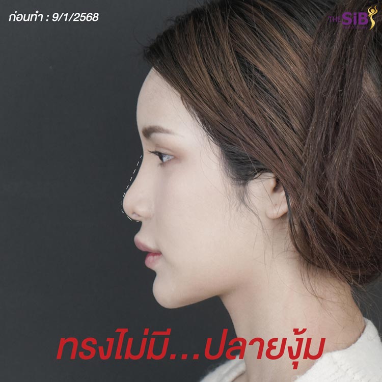 ปัญหาก่อนแก้จมูก ปลายตก แกนเอียง หายใจไม่ออก