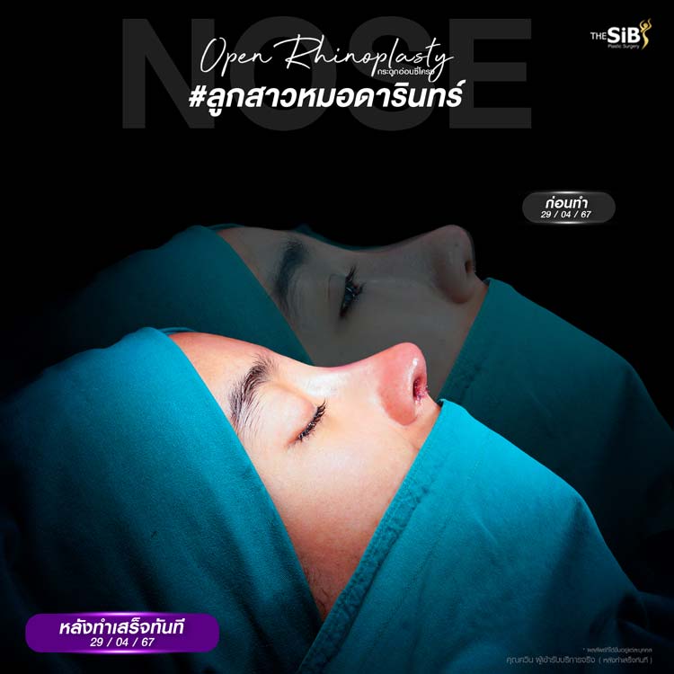 ปรึกษาและออกแบบทรงจมูกให้เข้ากับรูปหน้า The SiB Plastic Surgery