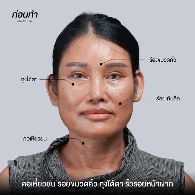 Pre-neck lift problems: sagging neck skin, signs of aging