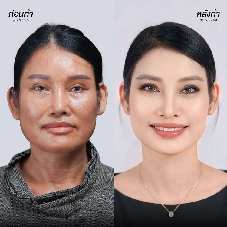 Consultation with a specialized doctor for neck and facelift assessment at The SiB
