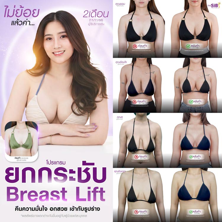 รีวิวยกกระชับหน้าอก