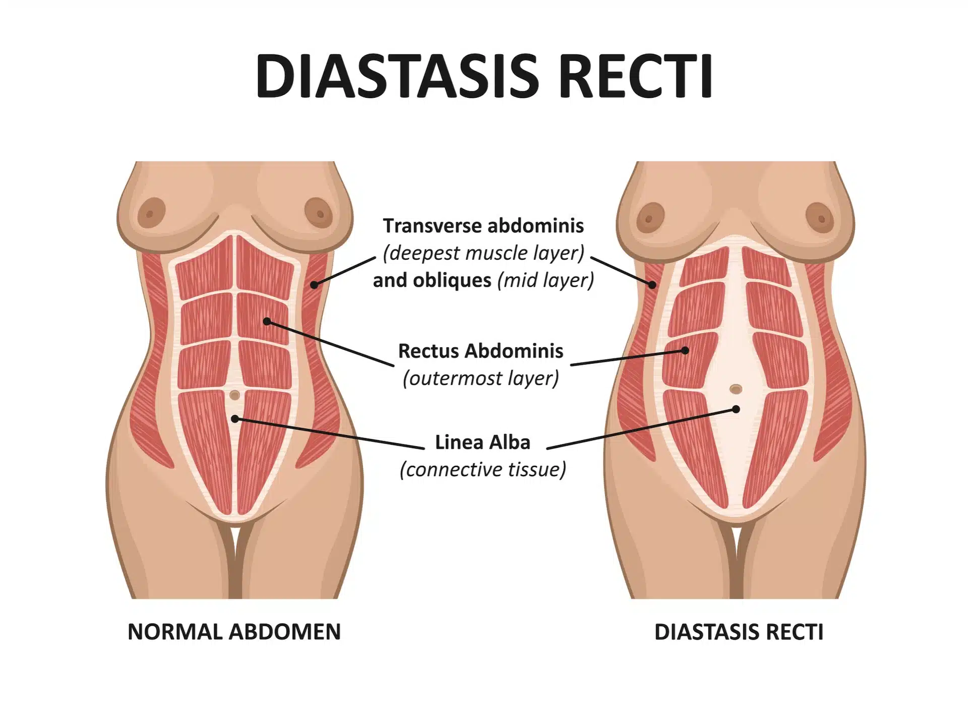 กล้ามเนื้อหน้าท้องแยกและการแก้ไขด้วย Tummy Tuck