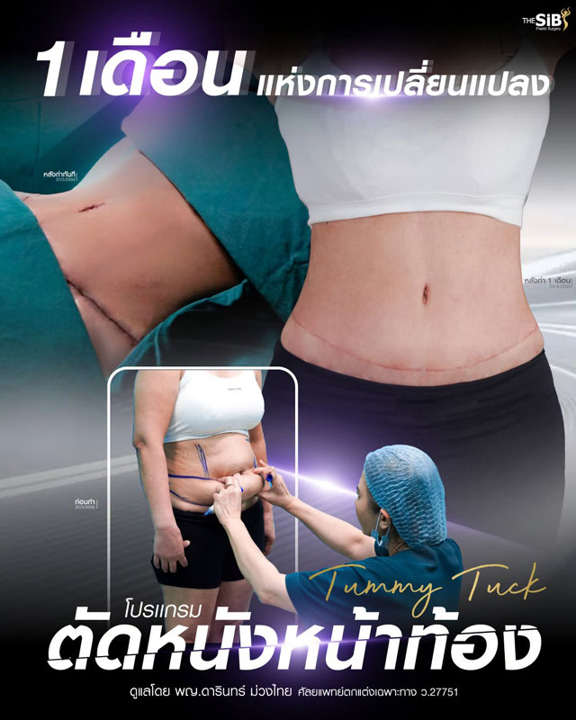 การทำ Tummy Tuck ที่ The SiB