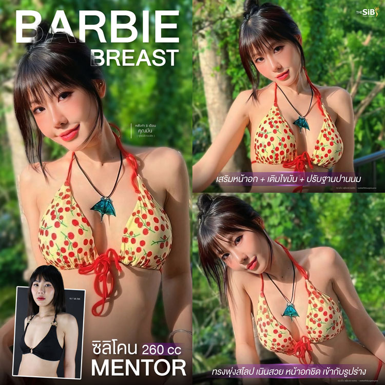รีวิวเสริมหน้าอก Motiva