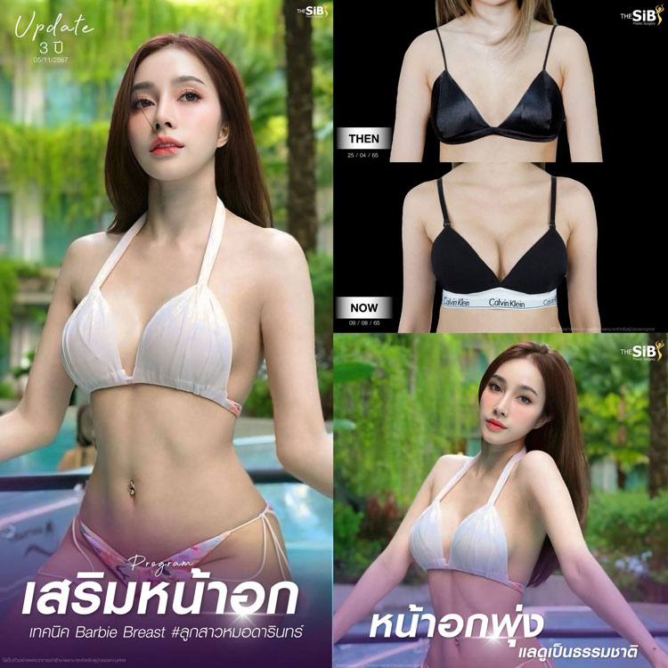 อินโฟกราฟิกจำลองเทคนิคการเลาะโพรงหน้าอก