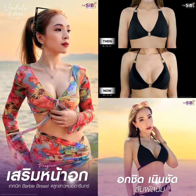 รีวิวเสริมหน้าอก