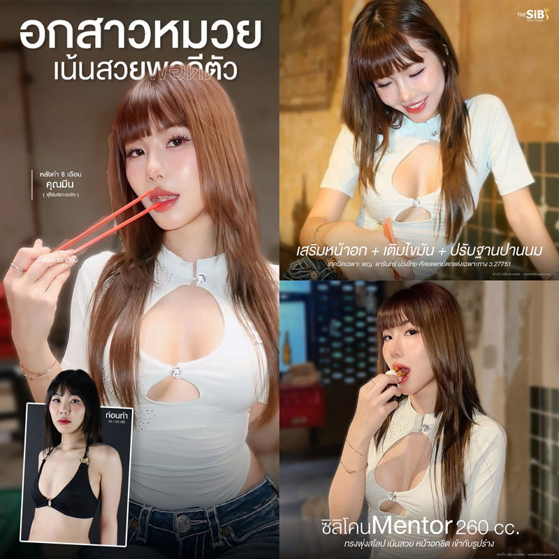 เสริมหน้าอก+เติมไขมัน รีวิว