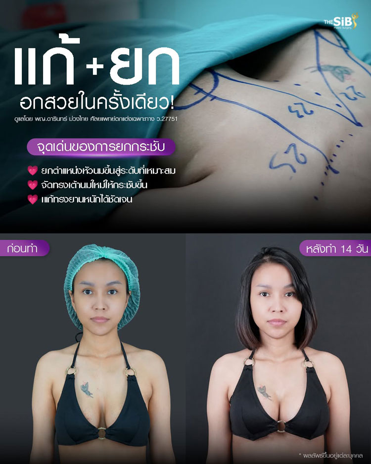 กราฟิกแสดงเทคนิคการเปิดแผลทั้ง 3 รูปแบบ