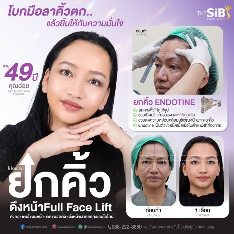 ผลลัพธ์ก่อนและหลังการยกคิ้วด้วย Endotine