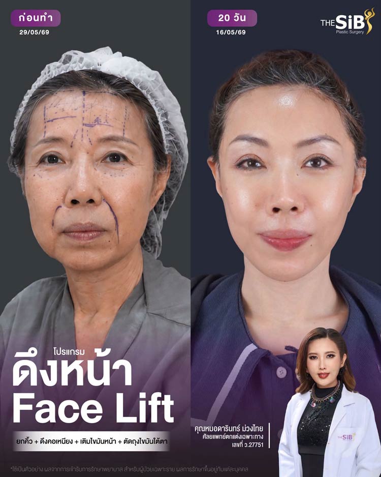 ผลลัพธ์ก่อนและหลังการยกคิ้วด้วย Endotine