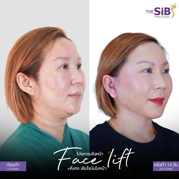 ประเมินปัญหาหนังตาตกและวางแผนทำ Subbrow Lift ร่วมกับดึงหน้า