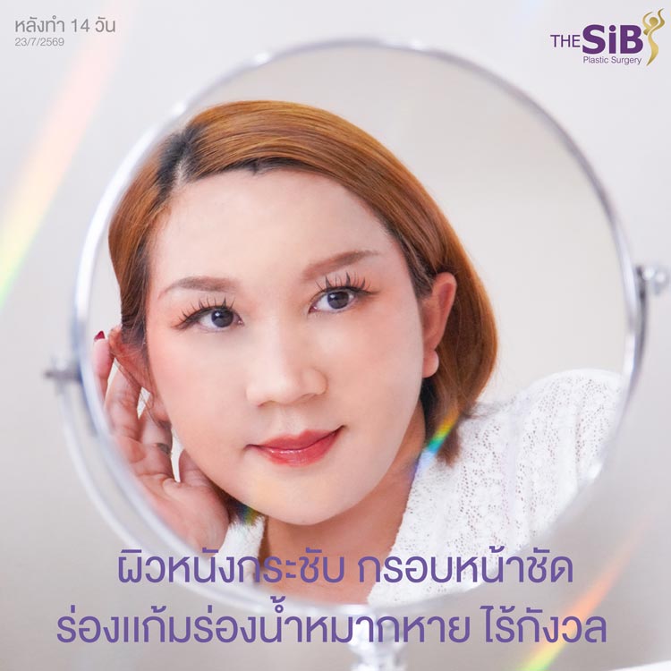 ผลลัพธ์หลังดึงหน้า Full Facelift และ เติมไขมัน หน้าอิ่มฟูดูเด็ก