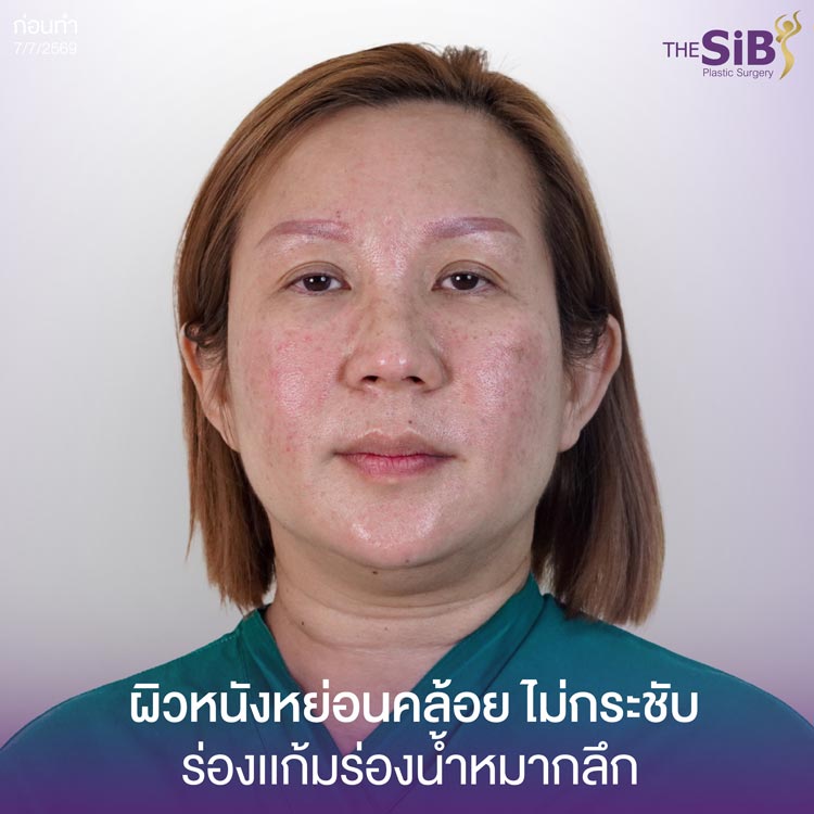 ปัญหาก่อนดึงหน้า ความหย่อนคล้อยรอบดวงตา หน้าผาก แก้ม และลำคอ