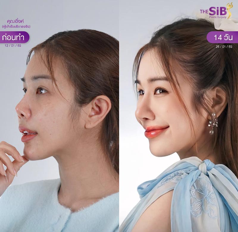 ความเรียบหรูและสมดุลของจมูกทรง Old Money