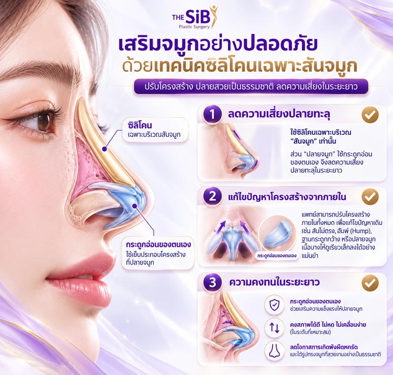 กราฟิกแสดงเทคนิค Open Rhinoplasty และการใช้กระดูกอ่อน