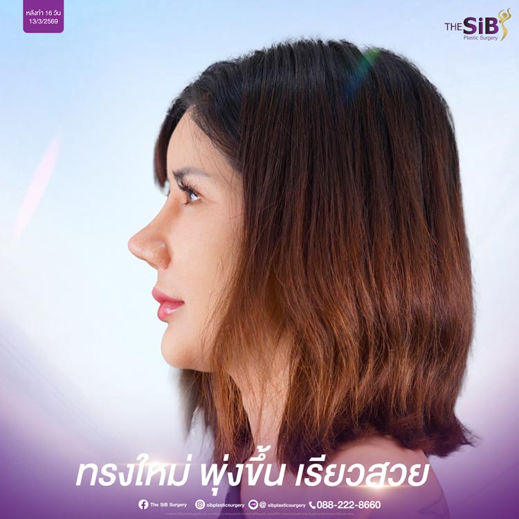 อัปเดตแก้จมูก 14 วัน จมูกตรงขึ้น ทรงสวยรับใบหน้า