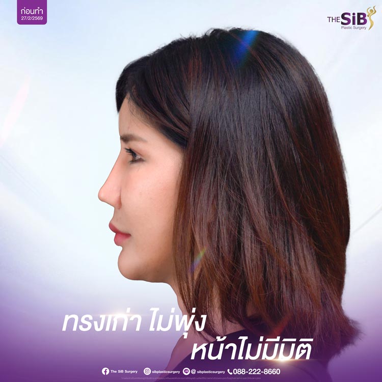 ปัญหาก่อนแก้จมูก จมูกเอียง ถ่ายรูปได้แค่มุมเดียว