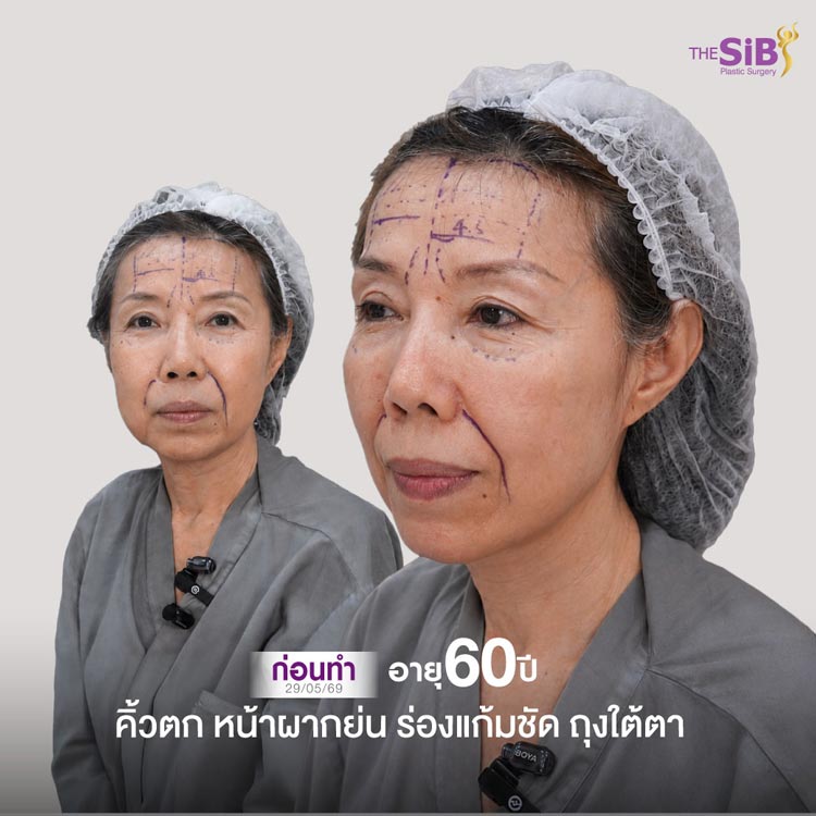 ปัญหาก่อนดึงหน้า ใบหน้าหย่อนคล้อย ดูเหนื่อยล้า หนังตาตก