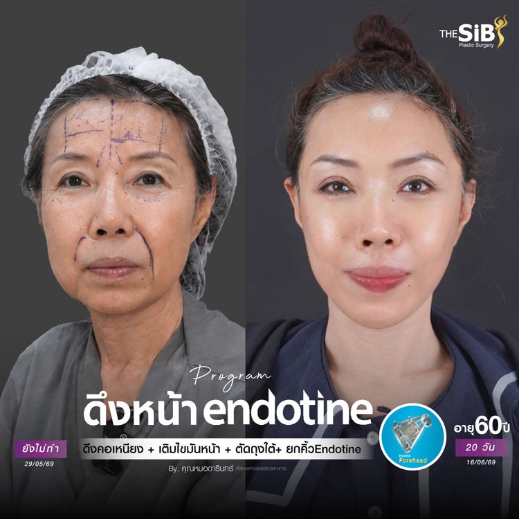 ผลลัพธ์หลังทำ Full Facelift 2 เดือน หน้าดูสดใส อ่อนเยาว์