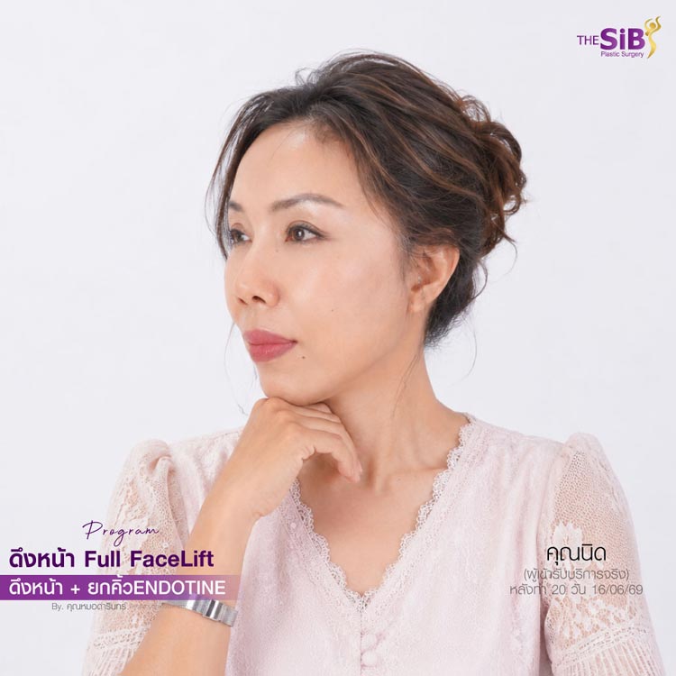 รอยแผลดึงหน้าสวยเนียน เทคนิคซ่อนแผล The SiB Plastic Surgery