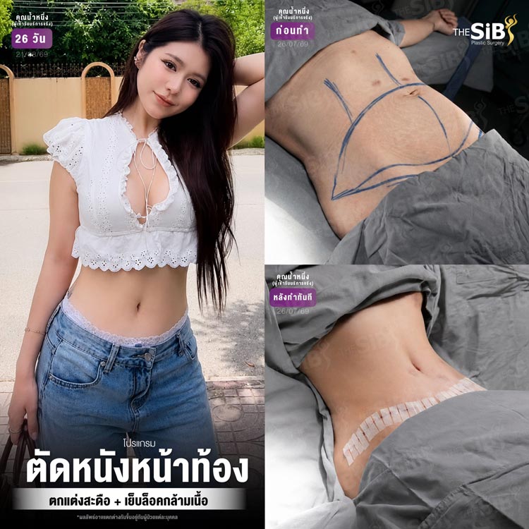 ผลลัพธ์ความมั่นใจจากการเสริมและยกกระชับหน้าอก