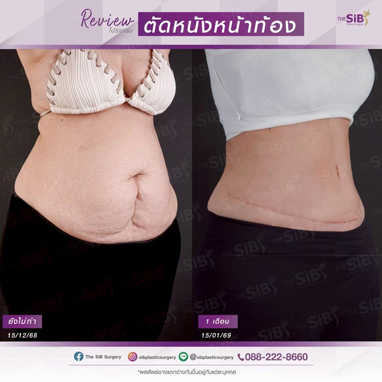ผลลัพธ์ความมั่นใจจากการเสริมและยกกระชับหน้าอก