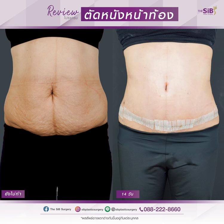 ผลลัพธ์ความมั่นใจจากการเสริมและยกกระชับหน้าอก