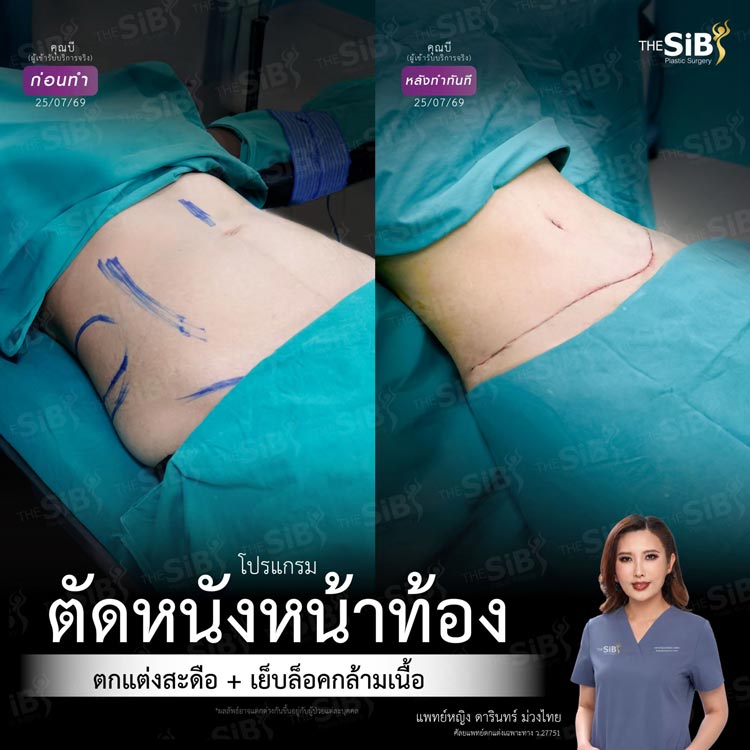 ผลลัพธ์ความมั่นใจจากการเสริมและยกกระชับหน้าอก