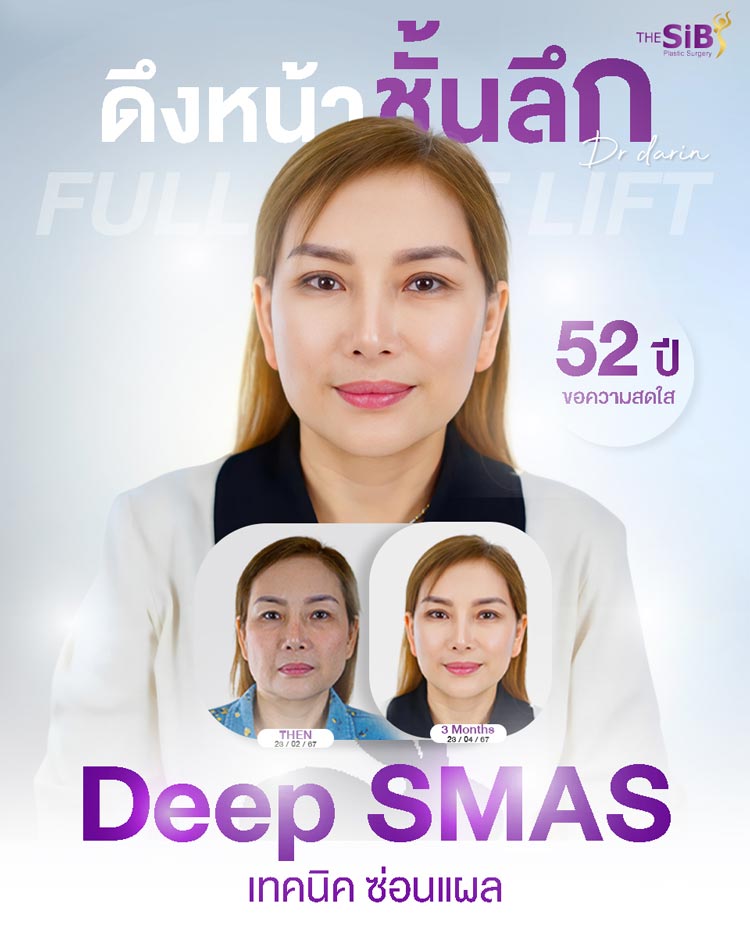 ความประทับใจในการดูแลหลังผ่าตัดดึงหน้าโดยทีมแพทย์ The SiB