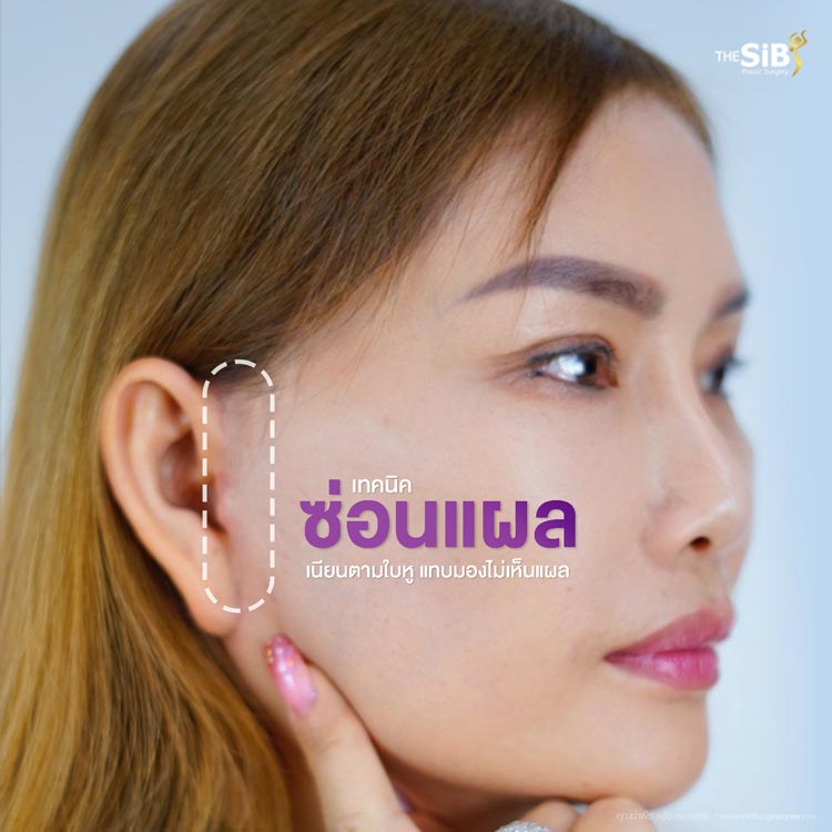 เทคนิคการดึงหน้าชั้นลึก Deep SMAS The SiB Plastic Surgery