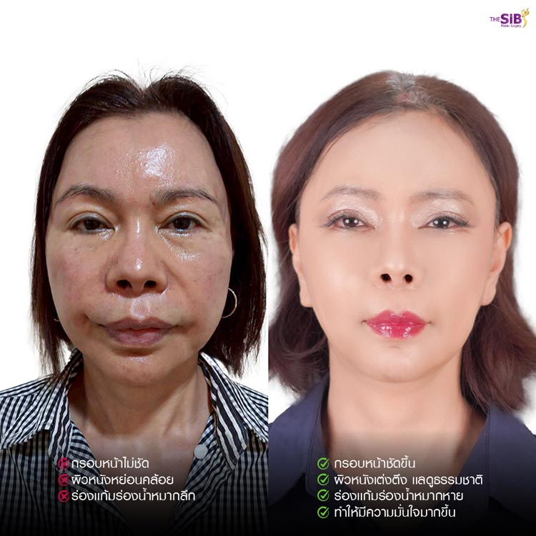 ปัญหาก่อนดึงหน้า ร่องแก้มลึก มุมปากไม่เท่ากัน ใบหน้าไม่สมมาตร