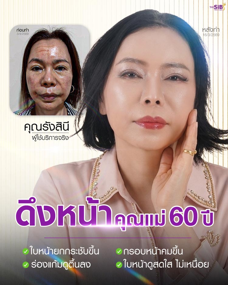 สรุปรีวิวดึงหน้า Full Facelift แม่รัน คืนความสดใสวัย 60