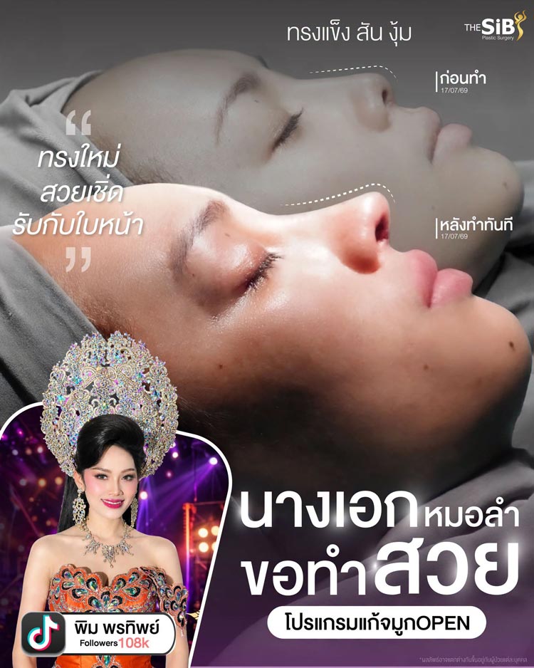 ผลลัพธ์การเสริมจมูกโอเพ่น มุมด้านข้าง