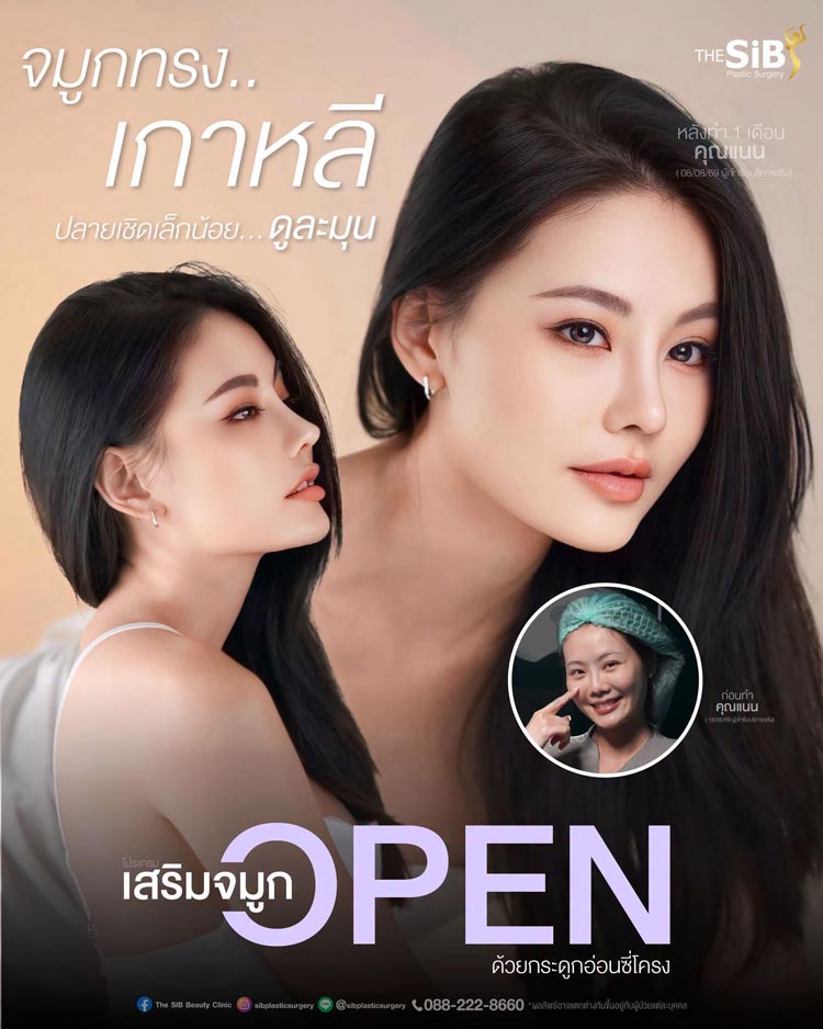 ผลลัพธ์การเสริมจมูกโอเพ่น มุมด้านข้าง