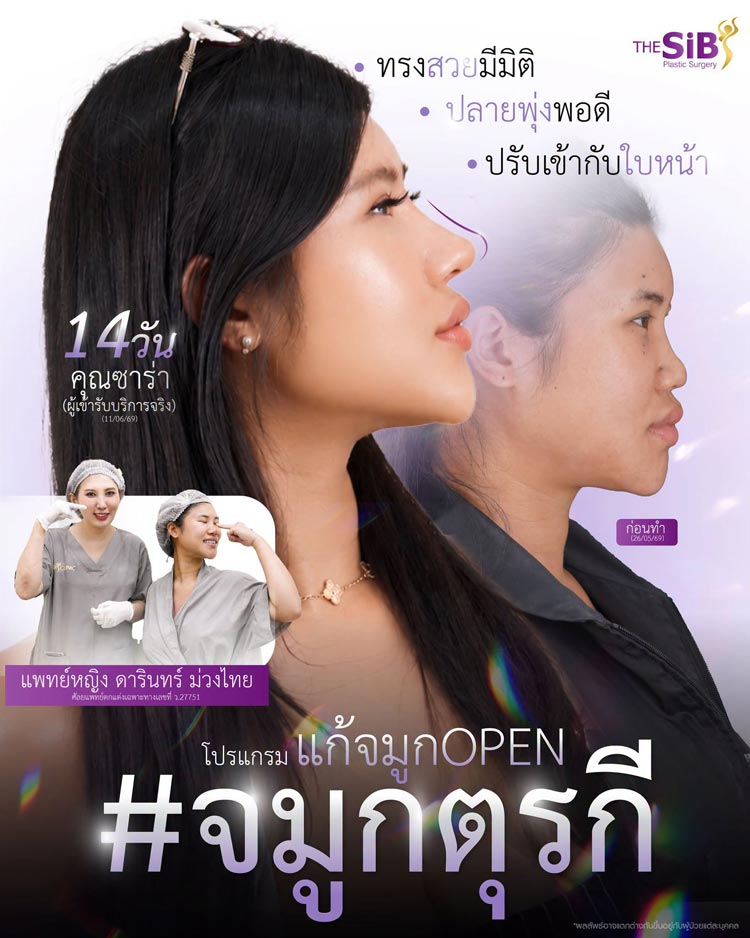 ผลลัพธ์การเสริมจมูกโอเพ่น มุมด้านข้าง